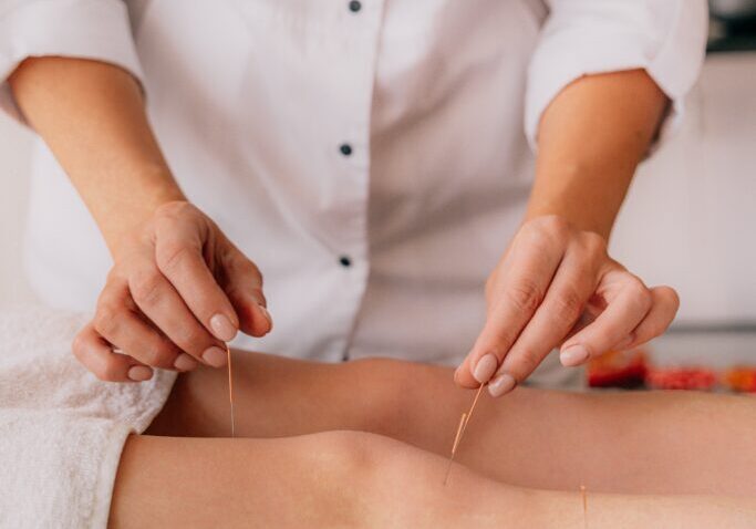 sports acupuncture